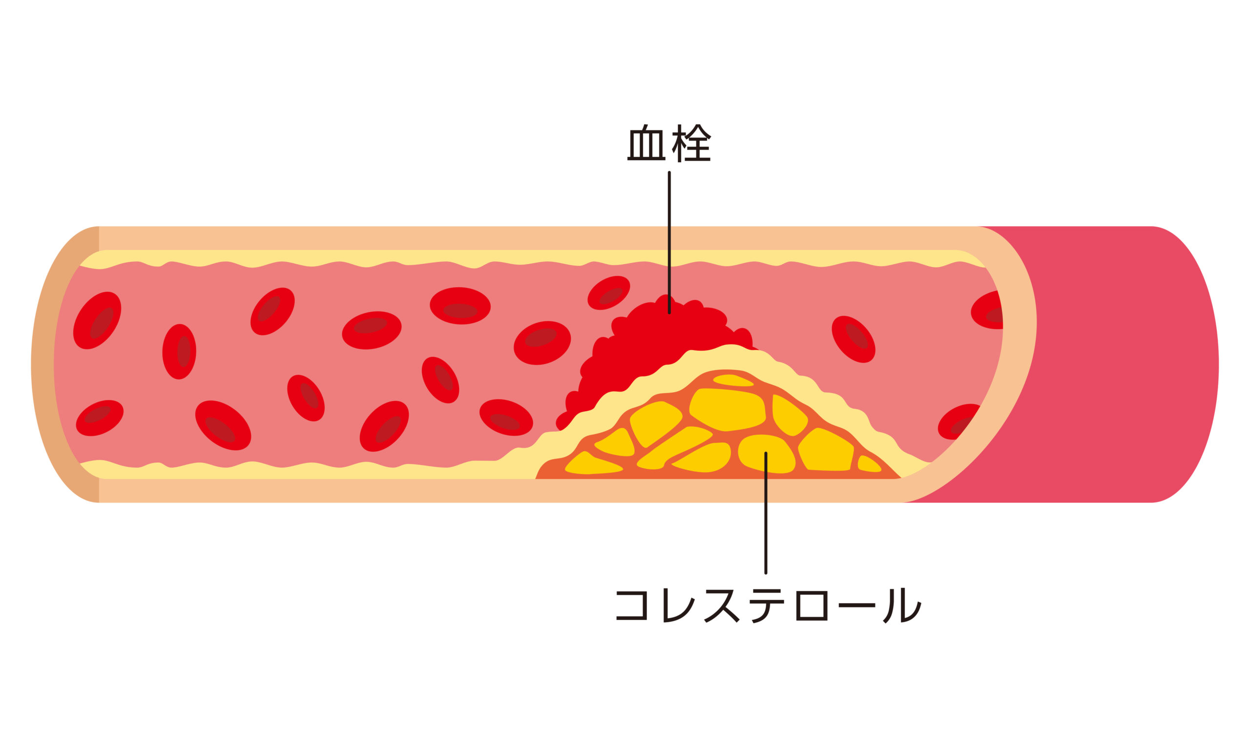 ミミズ 酵素 と 動脈 硬化